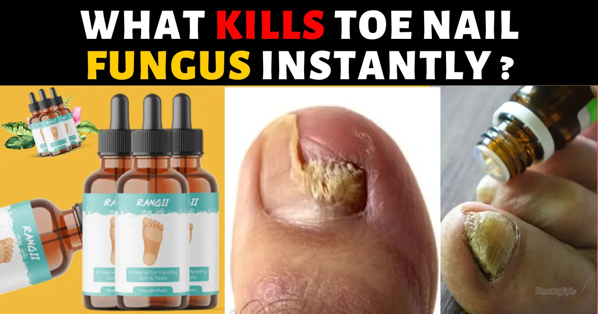 What Kills Toe nail Fungus Instantly 1